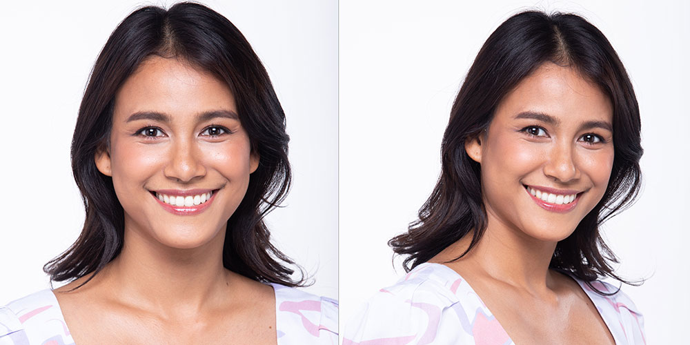 Gummy Smile Correction